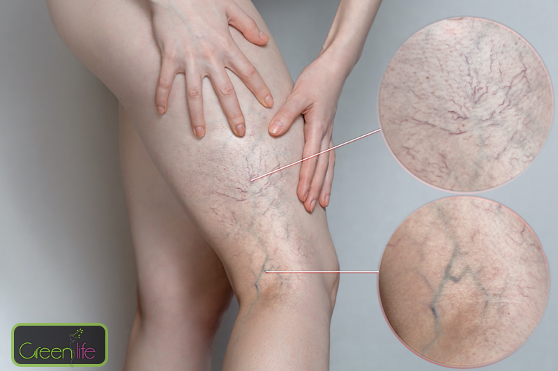 واریس چیست ؟ اهمیت تشخیص و درمان آن